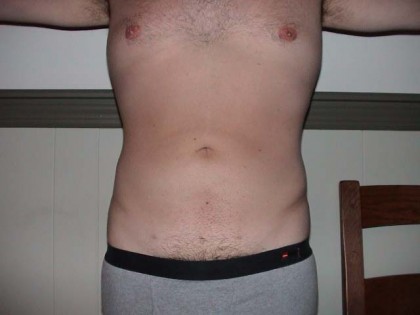 liposuction After