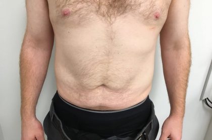 liposuction after