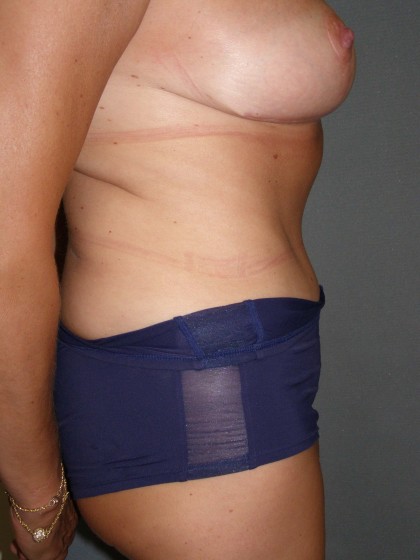 BREAST LIFT After