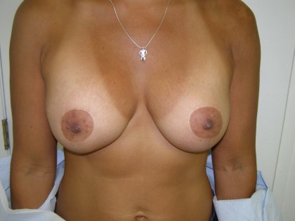 Breast Augmentation after