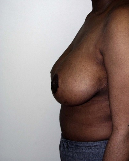 Breast-Reduction After