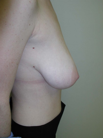 Breast-Reduction Before
