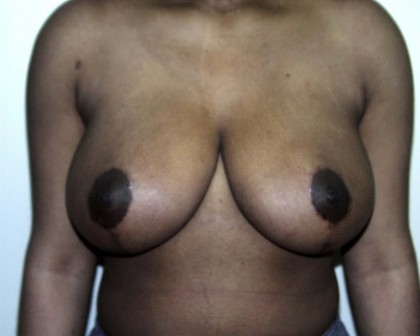 Breast-Reduction After