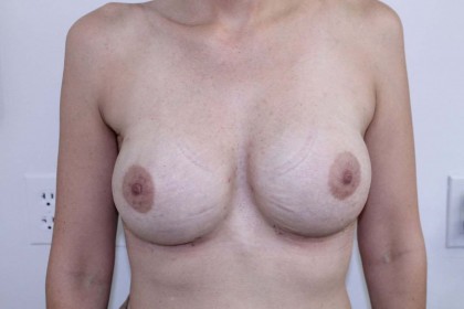 breast-augmentation after