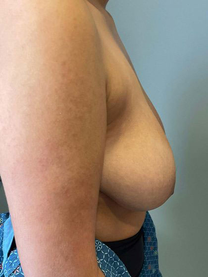 breast-augmentation before