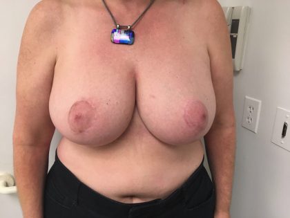 breast-reduction after