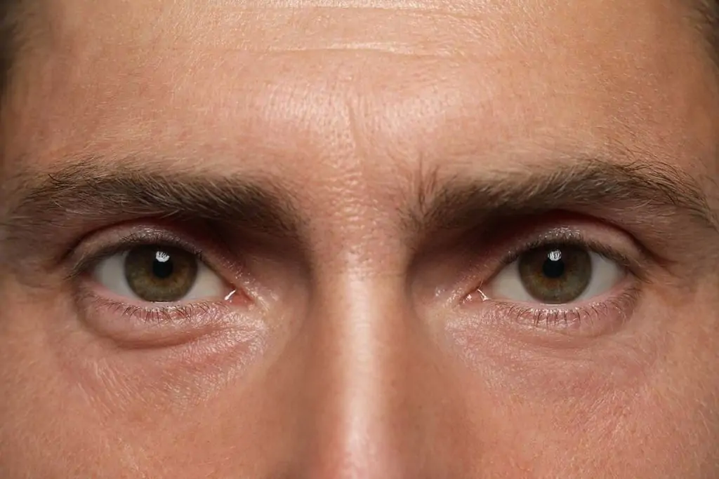 brow-lifts-for-men