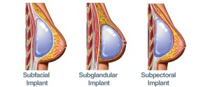 implant placement