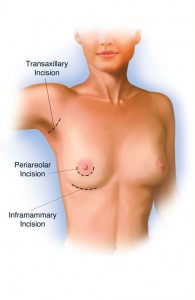 incision-placement