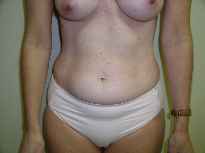 Liposuction Before & After Patient #323