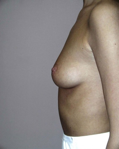 Breast Augmentation Before & After Patient #75