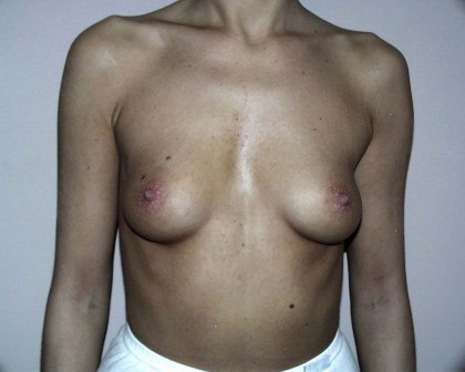 Breast Augmentation Before & After Patient #75