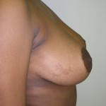 Breast Reduction Before & After Patient #199