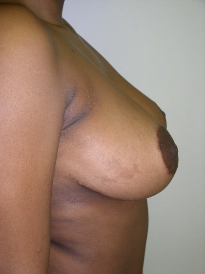 Breast Reduction Before & After Patient #199