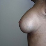 Breast Augmentation Before & After Patient #75
