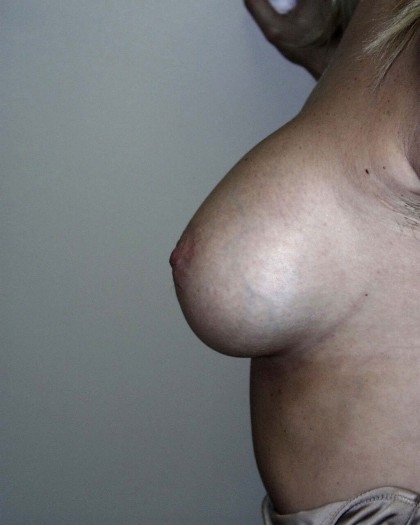 Breast Augmentation Before & After Patient #75