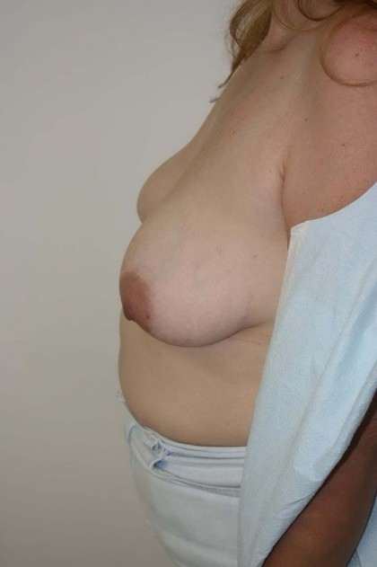 Breast Reconstruction Before & After Patient #173