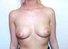 Breast Augmentation Before & After Patient #80