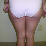 Liposuction Before & After Patient #323