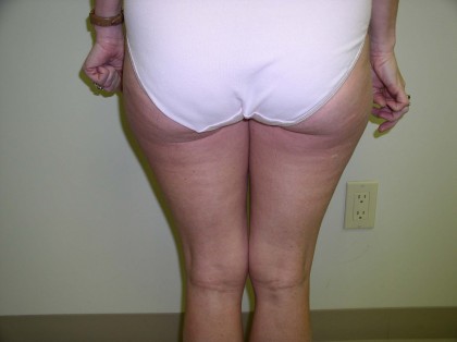 Liposuction Before & After Patient #323