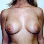 Breast Augmentation Before & After Patient #80