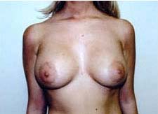 Breast Augmentation Before & After Patient #80