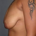 Breast Lift Before & After Patient #159