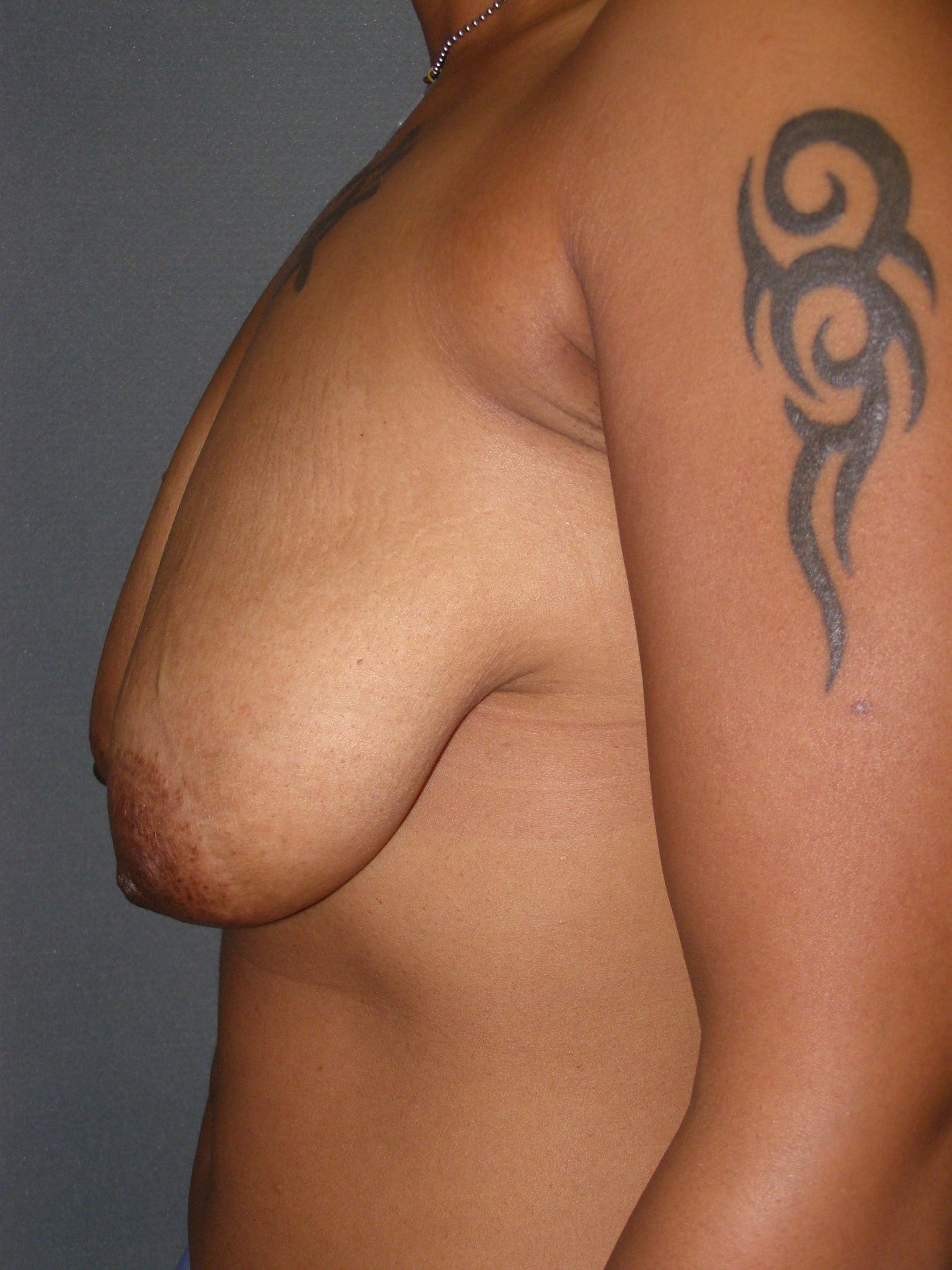 Breast Lift Before & After Patient #159