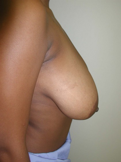 Breast Reduction Before & After Patient #199