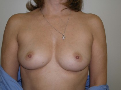 Breast Augmentation Before & After Patient #83