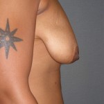 Breast Lift Before & After Patient #159