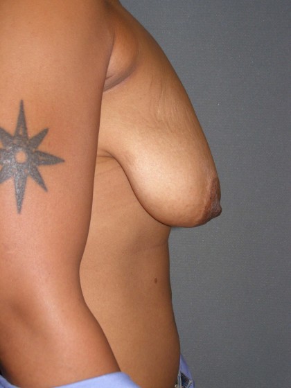 Breast Lift Before & After Patient #159