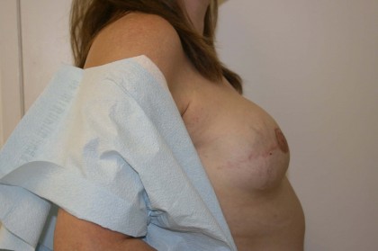 Breast Reconstruction Before & After Patient #173