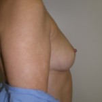 Breast Augmentation Before & After Patient #83