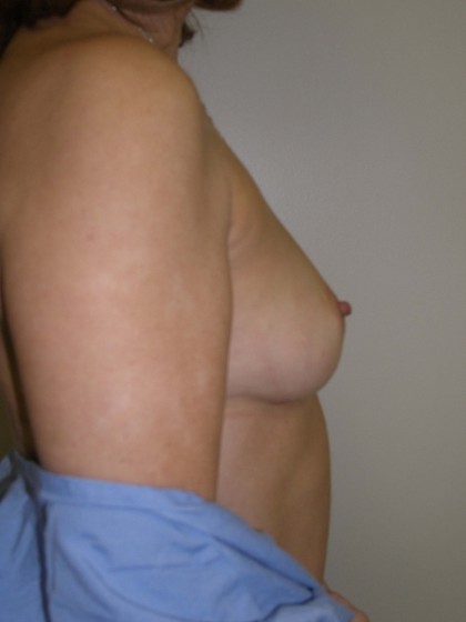 Breast Augmentation Before & After Patient #83