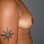 Breast Lift Before & After Patient #159