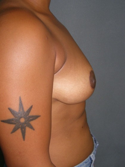 Breast Lift Before & After Patient #159
