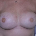 Breast Reconstruction Before & After Patient #181