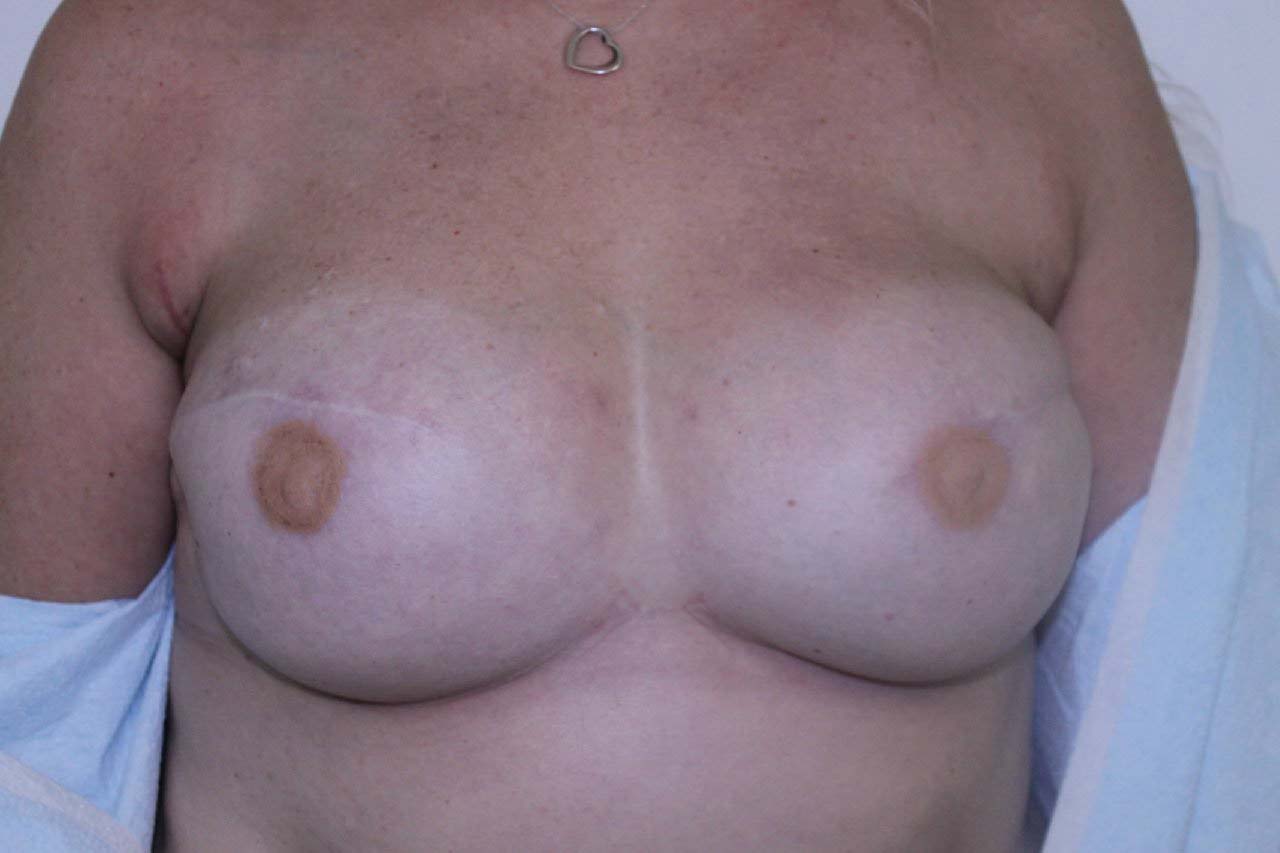 Breast Reconstruction Before & After Patient #181