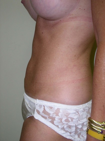 Liposuction Before & After Patient #323