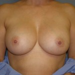 Breast Augmentation Before & After Patient #83