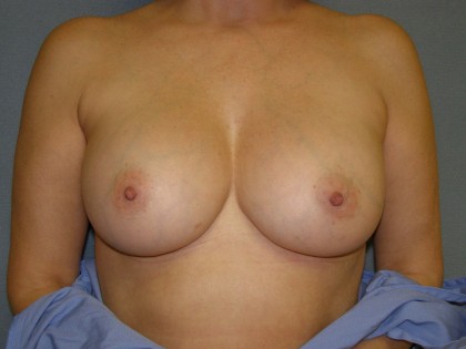 Breast Augmentation Before & After Patient #83