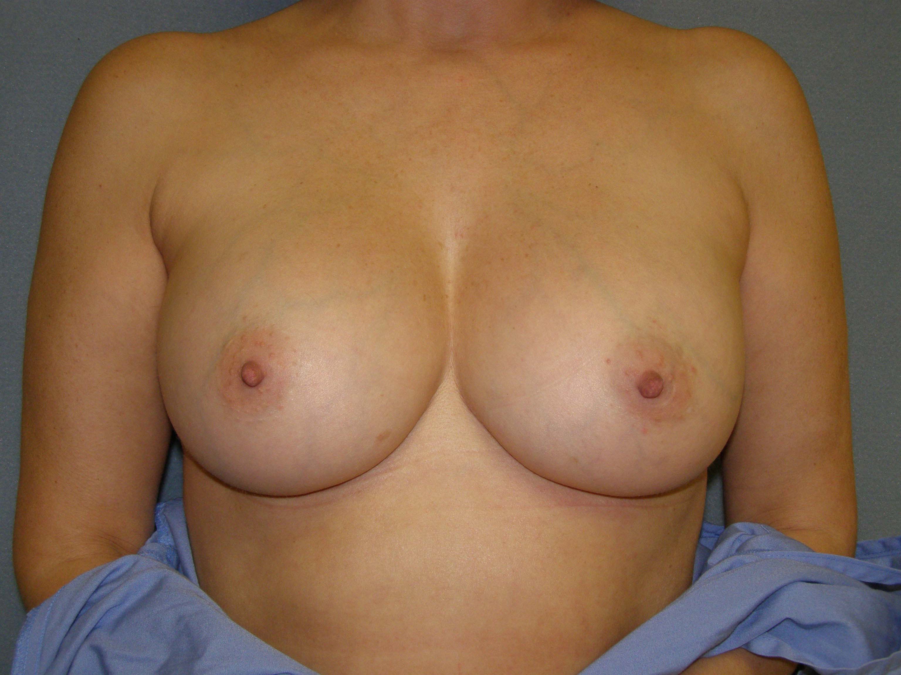 Breast Augmentation Before & After Patient #83