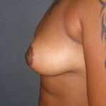Breast Lift Before & After Patient #159