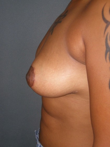 Breast Lift Before & After Patient #159