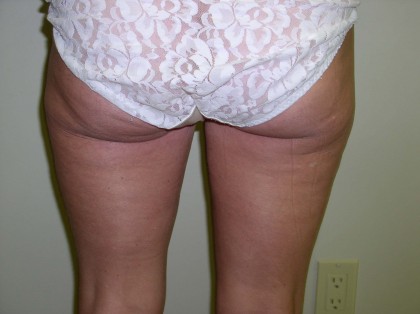 Liposuction Before & After Patient #323