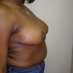 Breast Reduction Before & After Patient #206