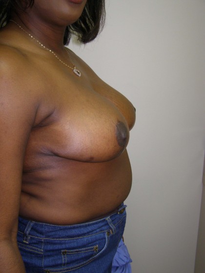 Breast Reduction Before & After Patient #206