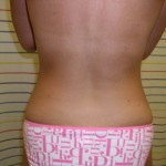 Liposuction Before & After Patient #333
