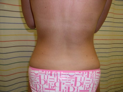 Liposuction Before & After Patient #333